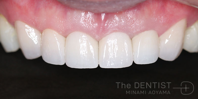 審美歯科、むし歯、ホワイトニングの症例画像
