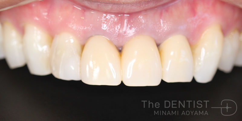 審美歯科、むし歯、ホワイトニングの症例画像