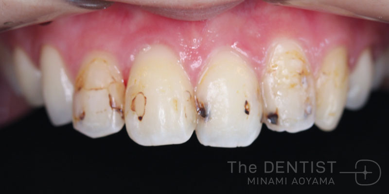 ひどいむし歯、セラミック治療、精密根管治療の症例画像