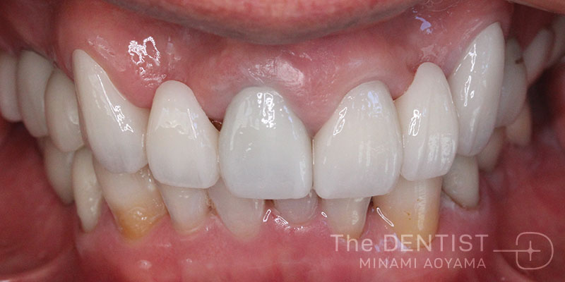 重度虫歯のフルマウス審美治療の症例画像