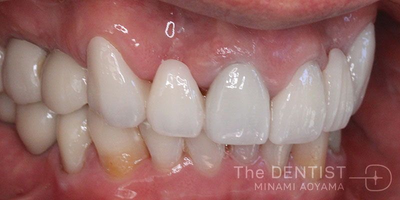 重度虫歯のフルマウス審美治療の症例画像