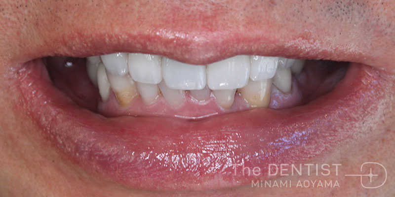 重度虫歯のフルマウス審美治療の症例画像