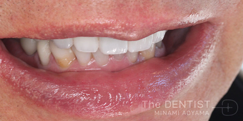 重度虫歯のフルマウス審美治療の症例画像