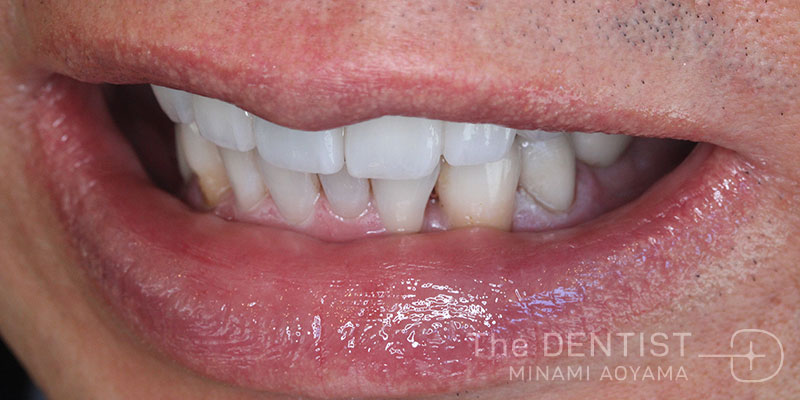 重度虫歯のフルマウス審美治療の症例画像