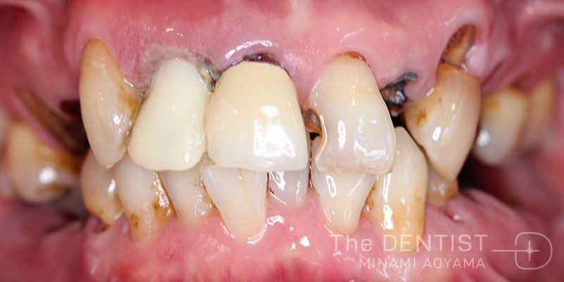 重度虫歯のフルマウス審美治療の症例画像