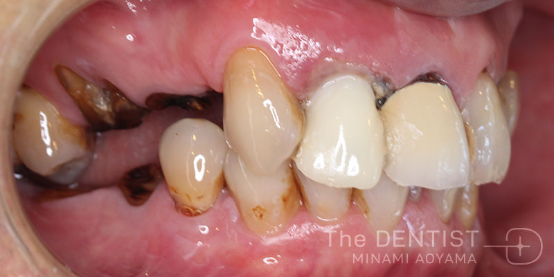 重度虫歯のフルマウス審美治療の症例画像