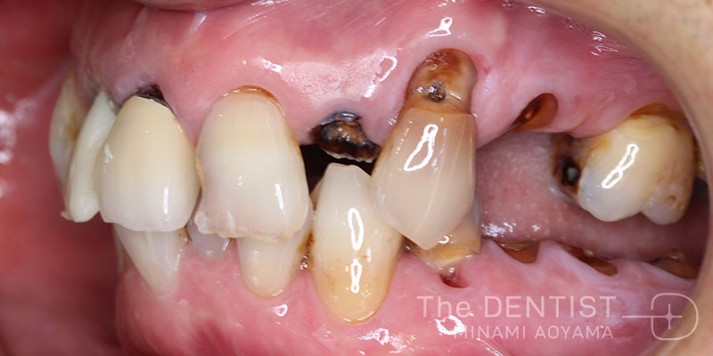 重度虫歯のフルマウス審美治療の症例画像