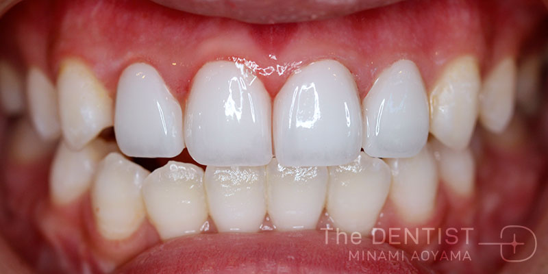 前歯の審美性改善の症例画像