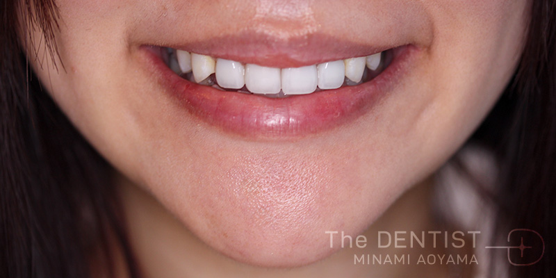 前歯の審美性改善の症例画像