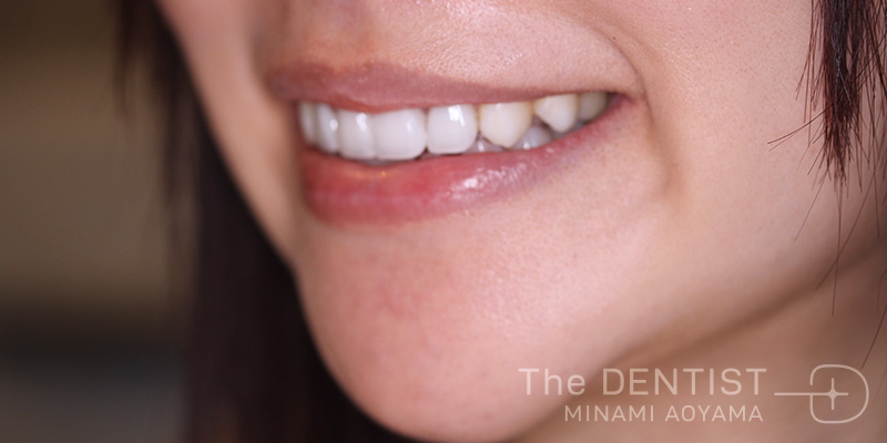 前歯の審美性改善の症例画像