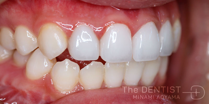前歯の審美性改善の症例画像
