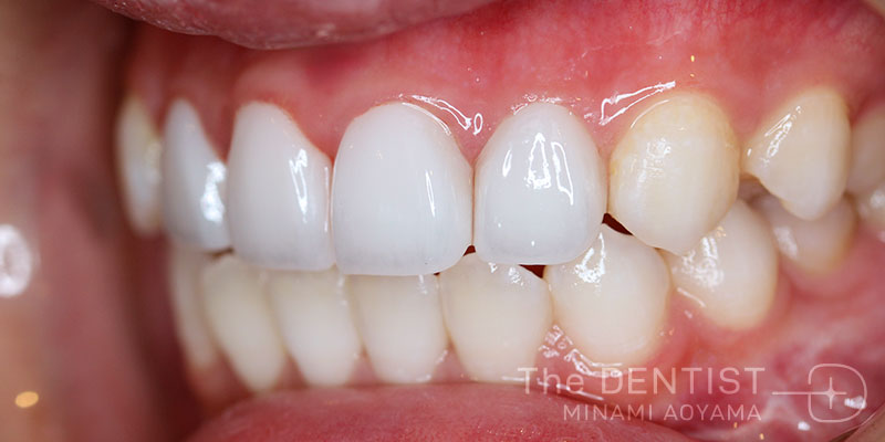 前歯の審美性改善の症例画像