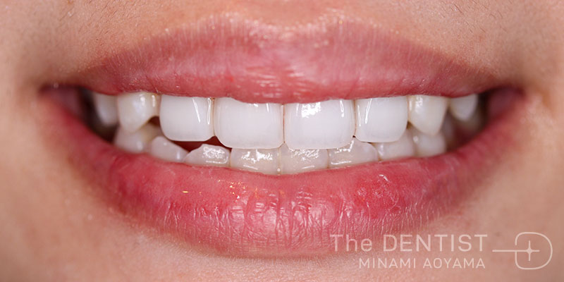 前歯の審美性改善の症例画像