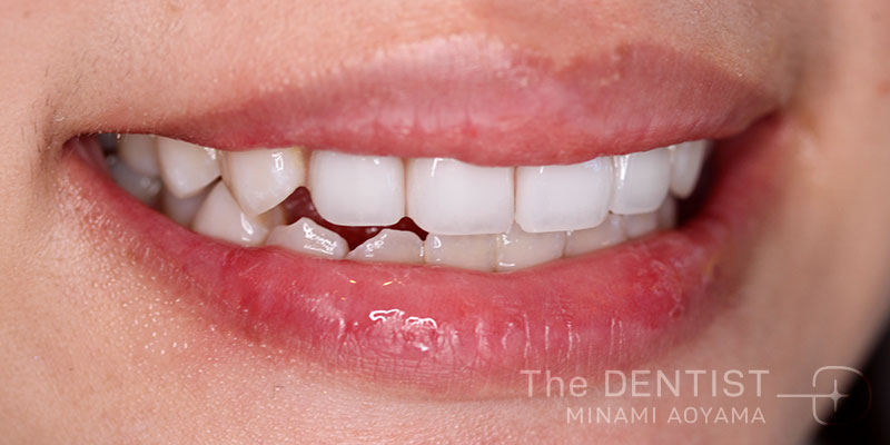 前歯の審美性改善の症例画像