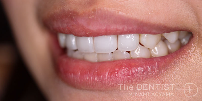 前歯の審美性改善の症例画像