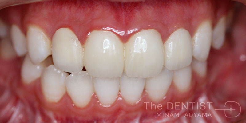 前歯の審美性改善の症例画像
