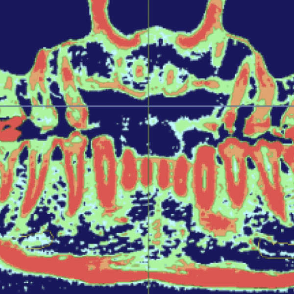 歯科CT画像